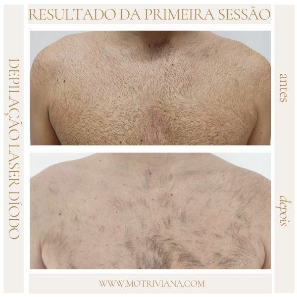 ad-laser3