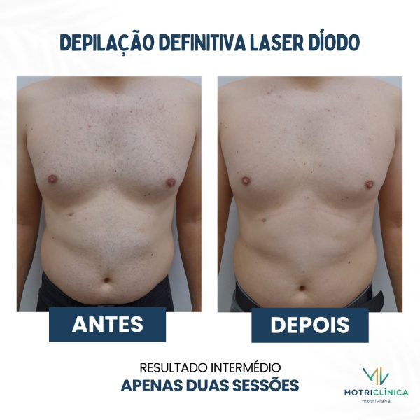 ad-laser4